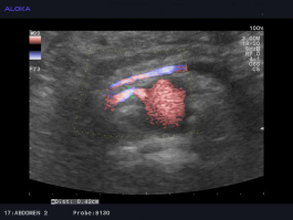 Ultrazvok žil trebuha - normalna ledvična arterija